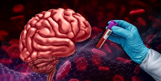 Exploring the Potential Role of Blood-Based Biomarkers in Identifying and Monitoring Alzheimer's Disease