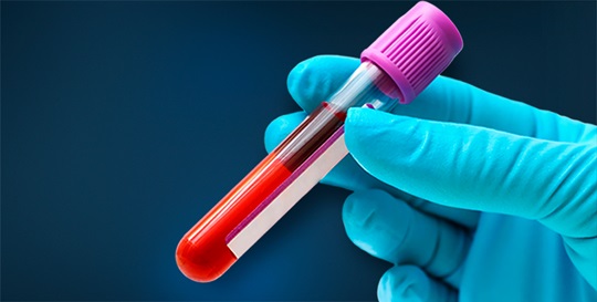 New PLA Code for Monocyte Distribution Width (MDW) Marker